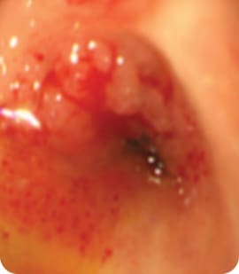 Endoluminal lesions before RFA treatment.
