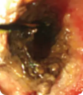 Result of using RFA treatment on endoluminal lesions.