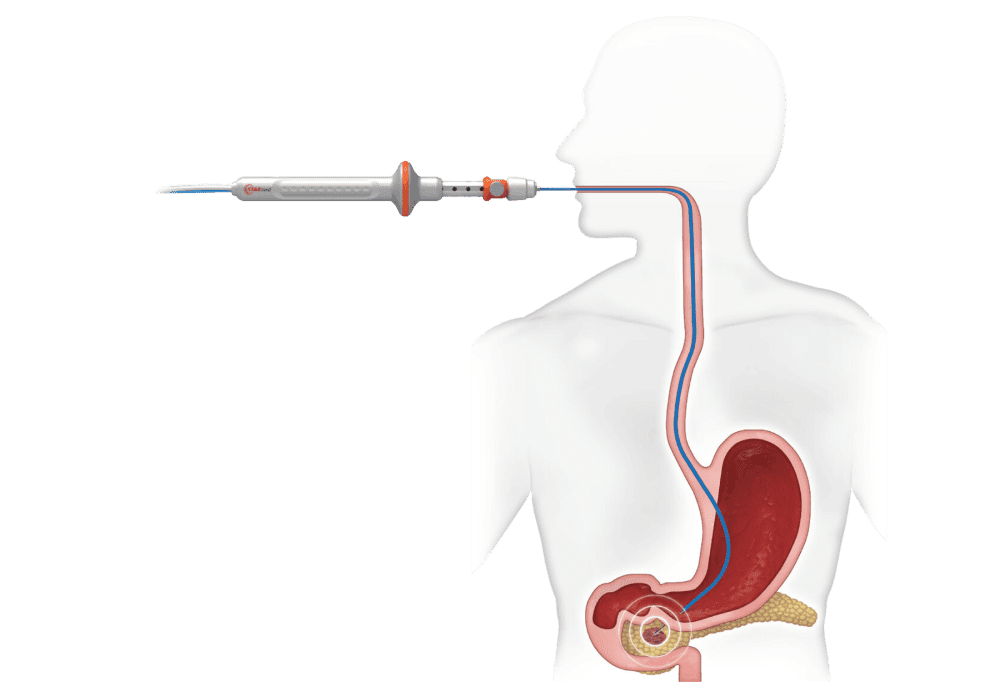 Image illustrates how the EUS RFA device is used inside the body, showing the probe inserted through the mouth and positioned near the pancreas to target a tumor for ablation.