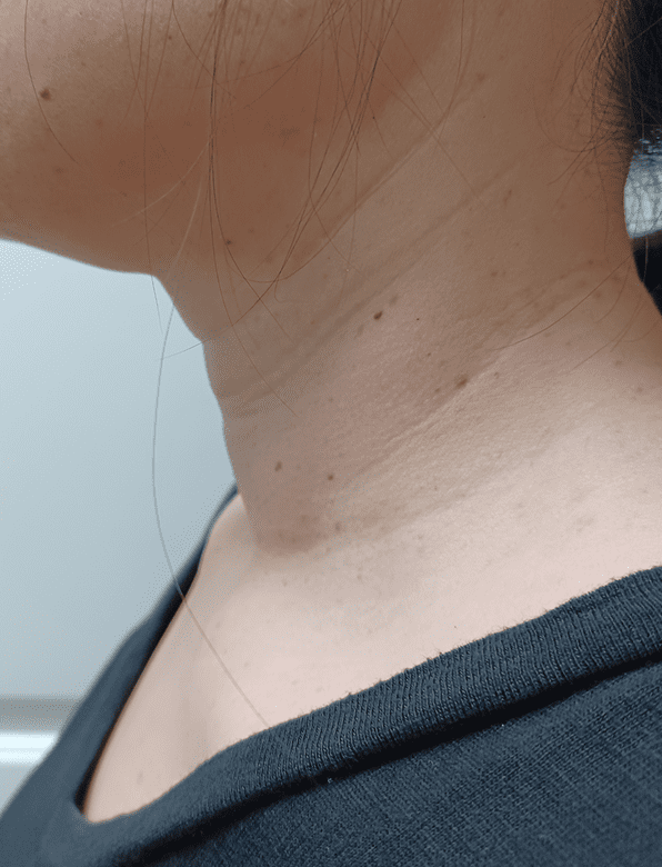 Patient's neck after STARMED America thyroid RFA