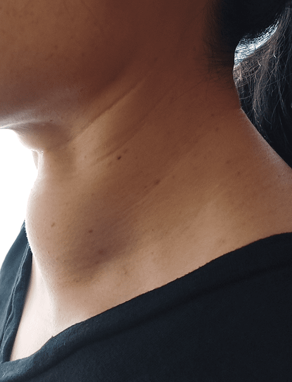 Patient's neck before STARMED America thyroid RFA