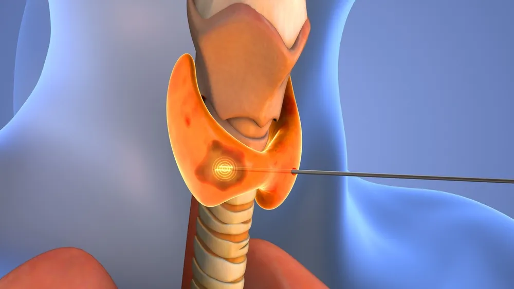 A 3D graphic showing a needle biopsy of the thyroid.