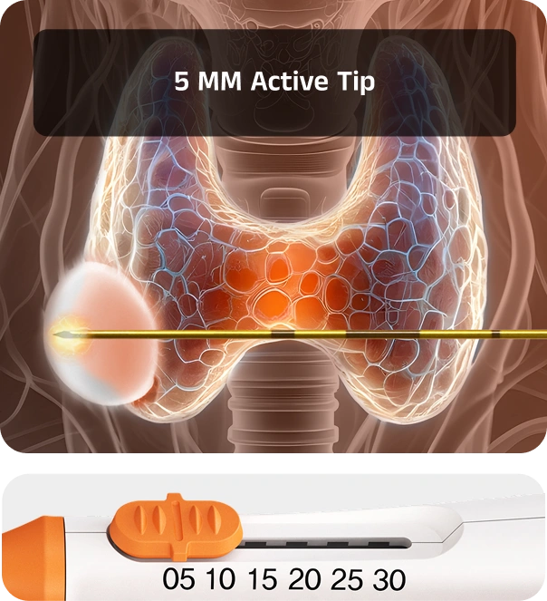 Diagram illustrating the VIVA II RF electrode treating multiple thyroid nodules of varying sizes
