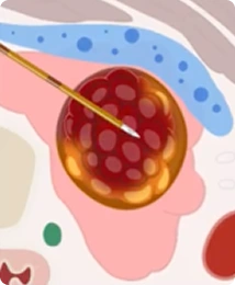 Diagram of Step 3: central nodule ablation with extended electrode tip and 3-5mm safety margin during STARMED America thyroid RFA