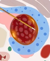 Diagram of Step 4: precise margin treatment with retracted electrode tip near the trachea and nerves under Doppler guidance during STARMED America thyroid RFA