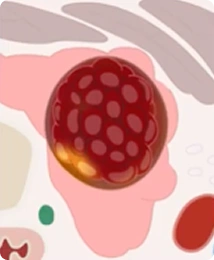 Diagram of Step 5: final confirmation of complete nodule ablation under real-time Doppler guidance during STARMED America thyroid RFA