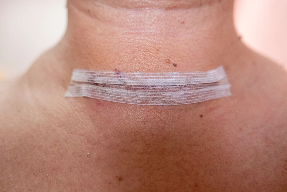 Close up of surgical thyroid scar and dressing.