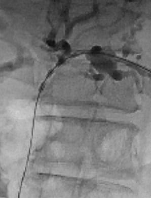 Fluoroscopic image of STARMED America ELRA RF ablation catheter in the left hepatic duct