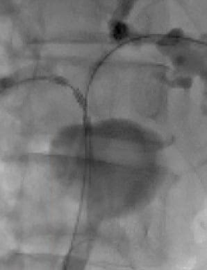 Fluoroscopic image of STARMED America ELRA RF ablation catheter in the right hepatic duct